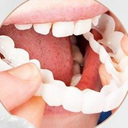 Luxora Facial Tooth Cover Retainer for a Perfect Smile