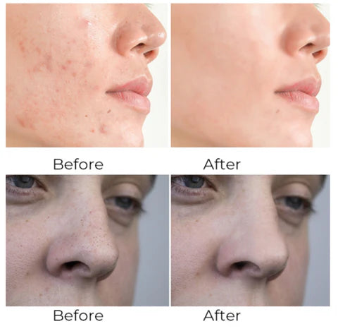 LuxRoyale Blackhead Remover Vacuum - Best Blackhead Remover