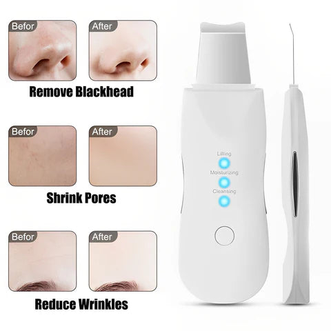 RoyaleGlow Top-Rated Ultrasonic Skin Scrubber Spatula