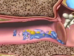 Royaleva Ear Cleaning Vacuum for Gentle Wax Removal