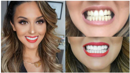 RoyaleGlow Smile Veneer (Upper & Lower Included) Set