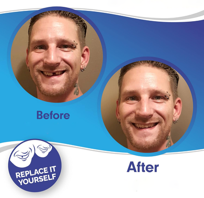 RoyaleGlow Smile Veneer (Upper & Lower Included) Set