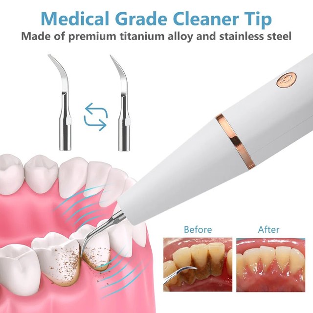 Royaleva Ultrasonic Scaling Wand for Efficient Tooth Cleaning