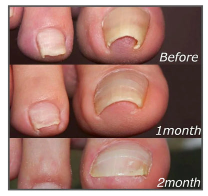 Royaleva Easy Patches - Correction Patches For Beautiful And Healthy Nails
