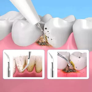 Royaleva Ultrasonic Scaler Plaque Remover for Home Use
