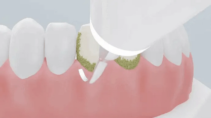 Royaleva Ultrasonic Scaling Wand for Efficient Tooth Cleaning