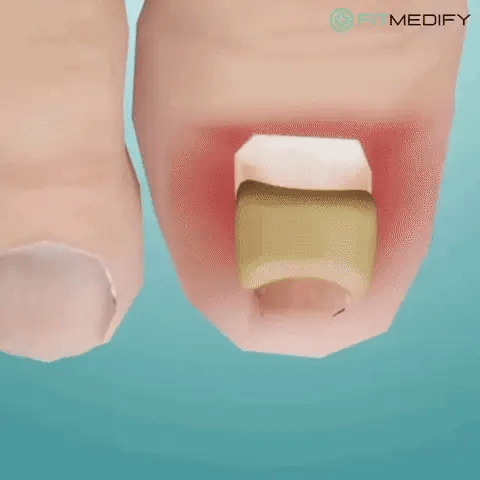Royaleva Easy Patches - Correction Patches For Beautiful And Healthy Nails