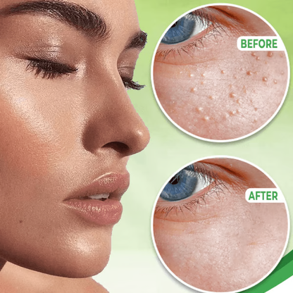 RoyaleGlow Eye Milia Removal Cream for Youthful Skin
