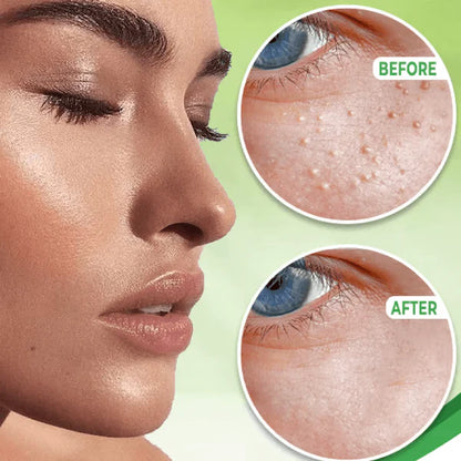 RoyaleGlow Eye Milia Removal Cream for Youthful Skin