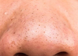 Luxora Blackhead Mask for Clearer, Radiant Skin 50g