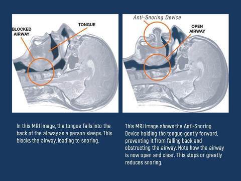 Luxora Apnea Tongue Stabilizing Device for Snoring Relief