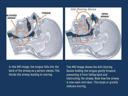 Luxora Apnea Tongue Stabilizing Device for Snoring Relief