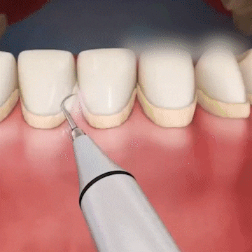 Royaleva Ultrasonic Scaling Wand for Efficient Tooth Cleaning